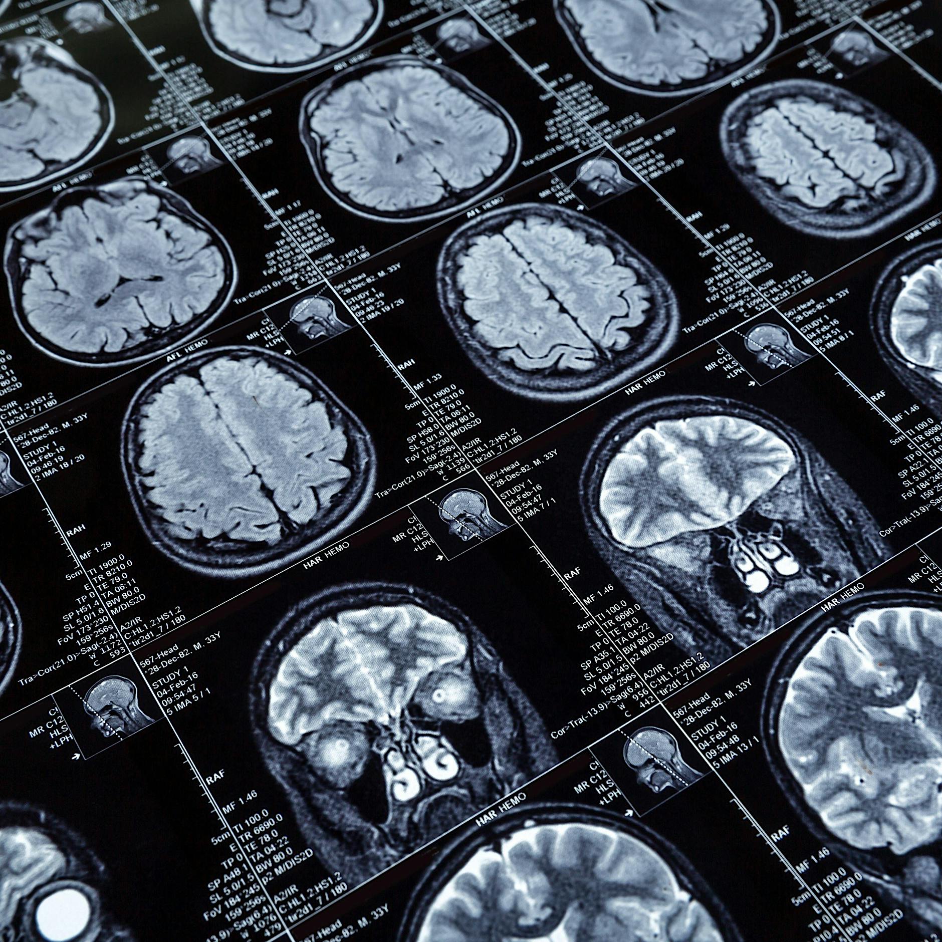 Borreliose als Demenz-Ursache: Warum reagiert die Forschung nicht?