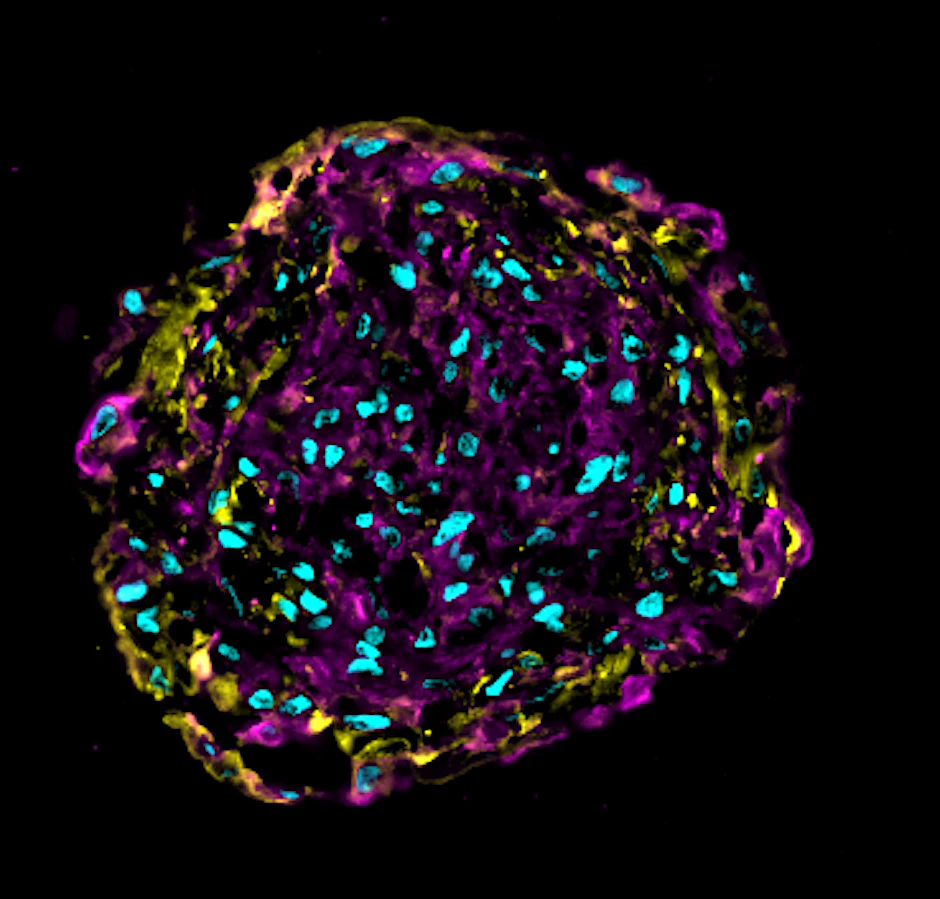 Ein funktionelles, eigenständig schlagendes Miniherz. Das Organoid besteht aus Herzmuskelzellen (Kardiomyozyten, in Pink), kardialen Fibroblasten (Bindegewebszellen, in Gelb) und Endothelzellen (Gefäßzellen, Zellkerne in Blau).