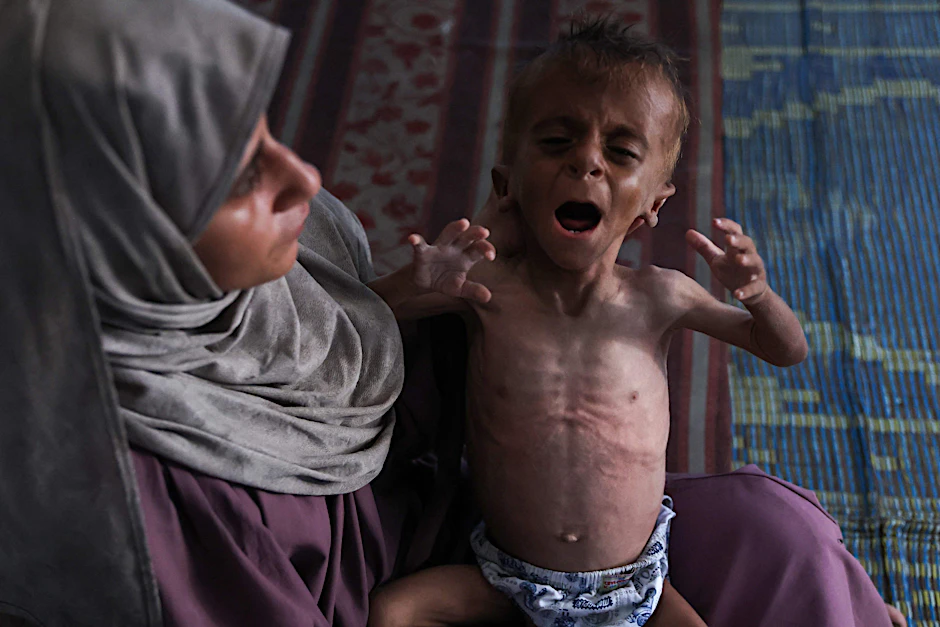 Bilder des Grauens: Ein ausgehungertes, 18 Monate altes Kind im Gazastreifen kämpft ums Überleben.