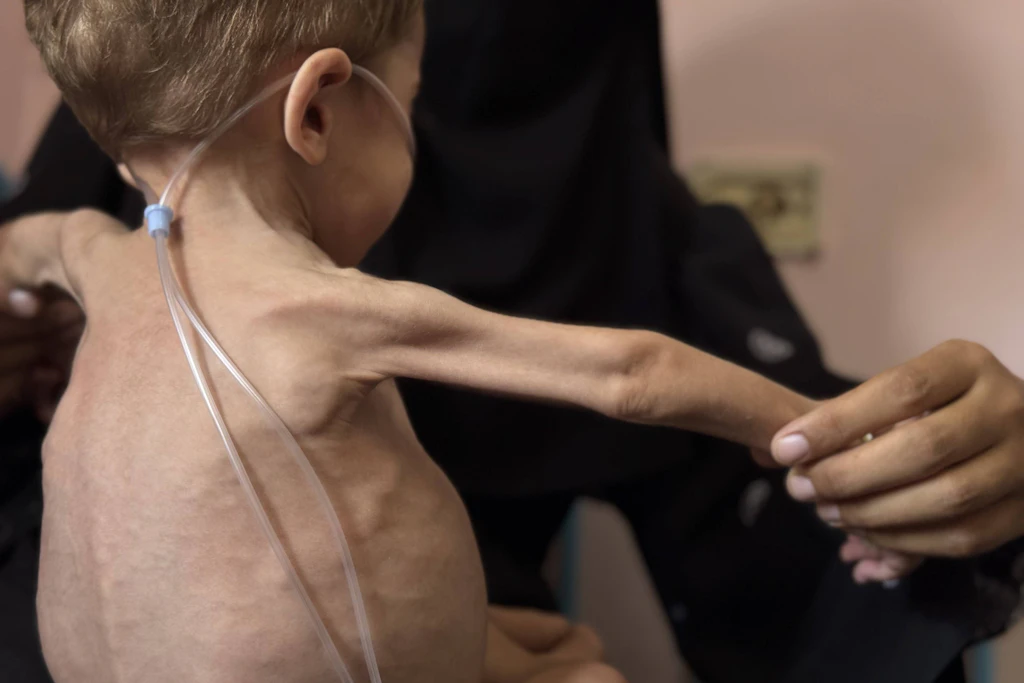 Ein dreijähriger Junge, der an schwerer Unterernährung, Lebervergrößerung, Knochenerweichung, Niereninsuffizienz und schweren Brustinfektionen leidet, wird im Nasser-Krankenhaus in Chan Yunis behandelt.