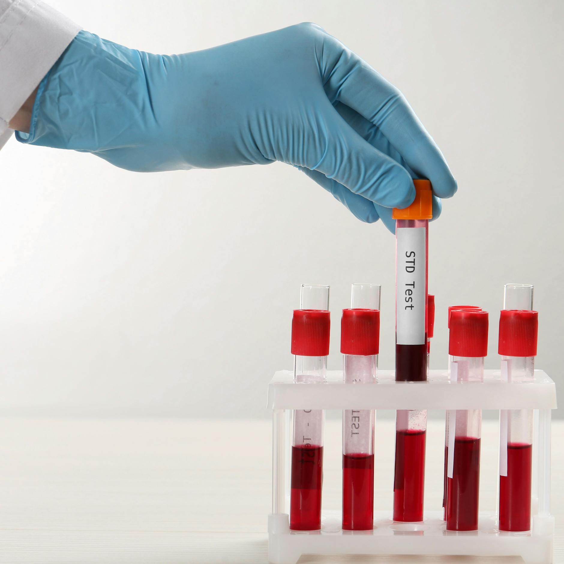 Image - Zahl der Syphilisfälle steigt weiter – Berlin am stärksten betroffen