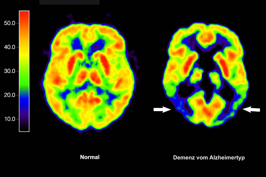 Die mit der Positronen-Emissions-Tomografie erstellte Abbildung zeigt die Gegenüberstellung zweier Gehirne – im gesunden Zustand (l.) und mit Alzheimer-Krankheit.