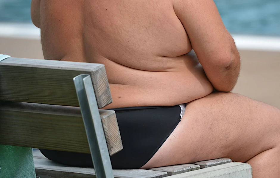 Ein übergewichtiger Mann in Badehose: Experten warnen vor Mangelernährung trotz Adipositas.