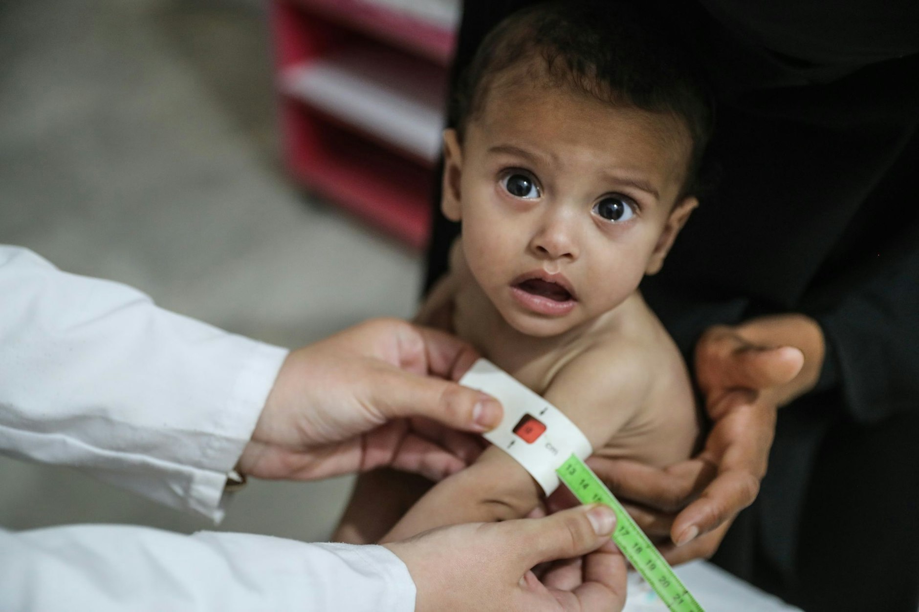 Ein syrisches Kind wird im Ibn-Sina-Krankenhaus aufgrund von Unterernährung medizinisch behandelt.