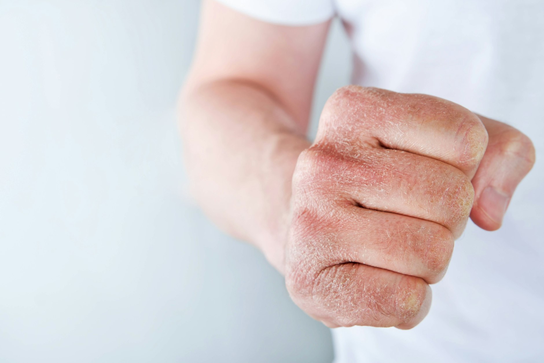 Urea ist die Antwort für trockene Hände in der Kälte.