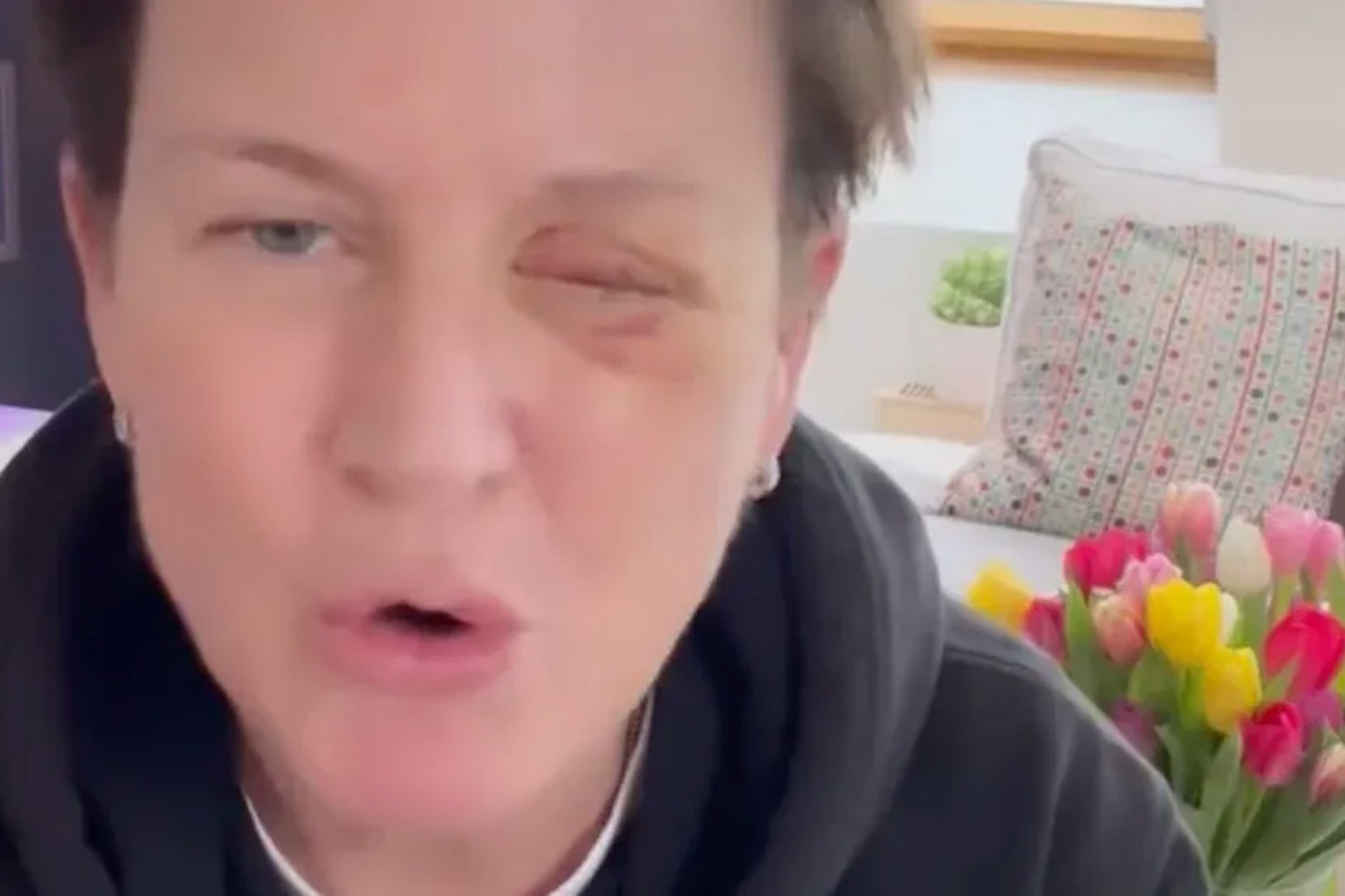 TV-Star Andrea Plewig verliert durch einen Böller-Unfall ein Augenlicht.