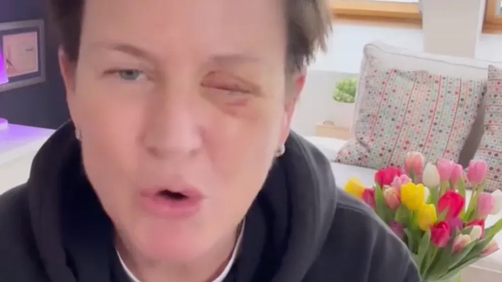 TV-Star-verliert-wegen-B-ller-sein-Augenlicht