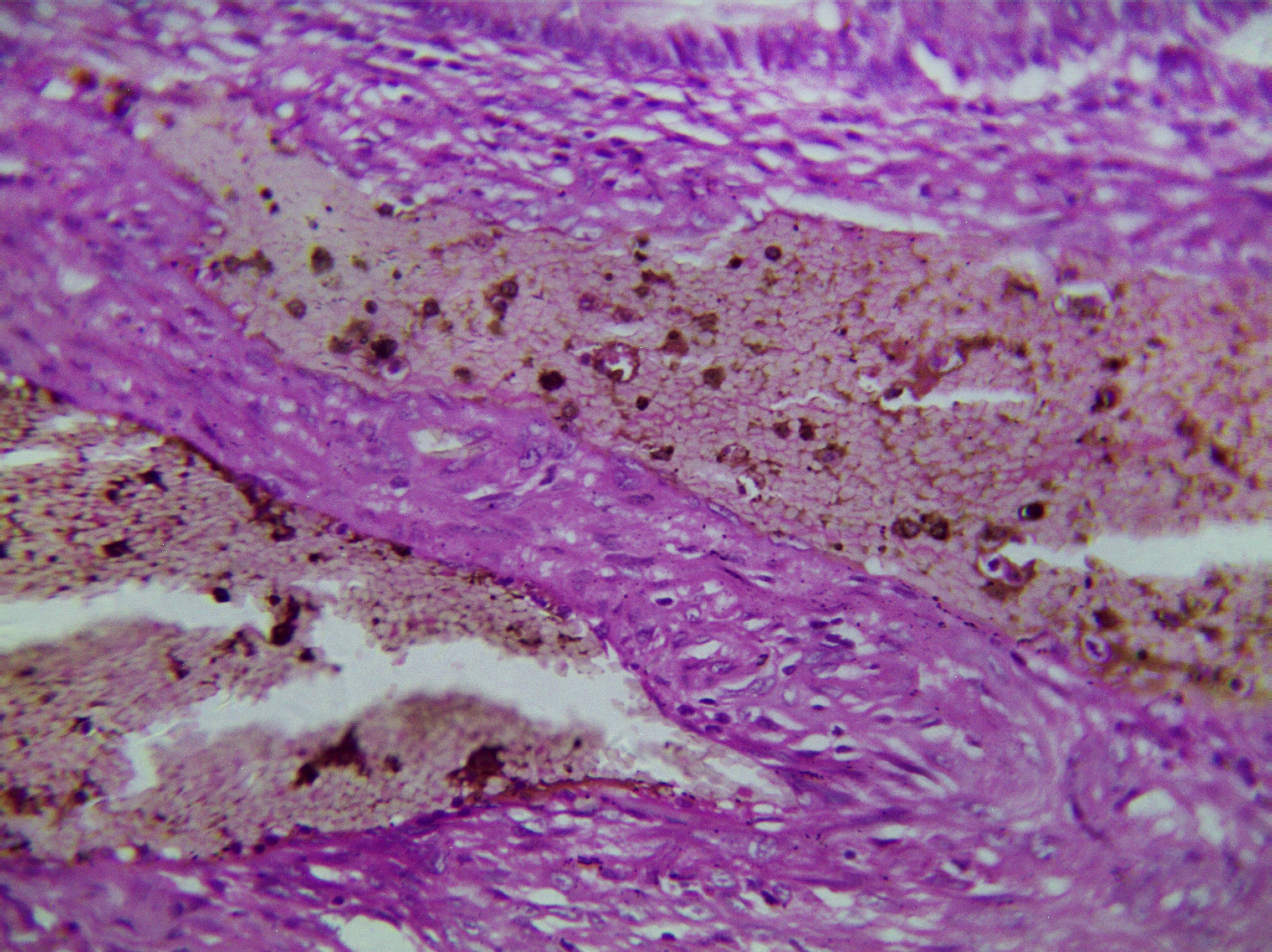 Neue Langzeitstudie: Was das Darmkrebsrisiko deutlich erhöht