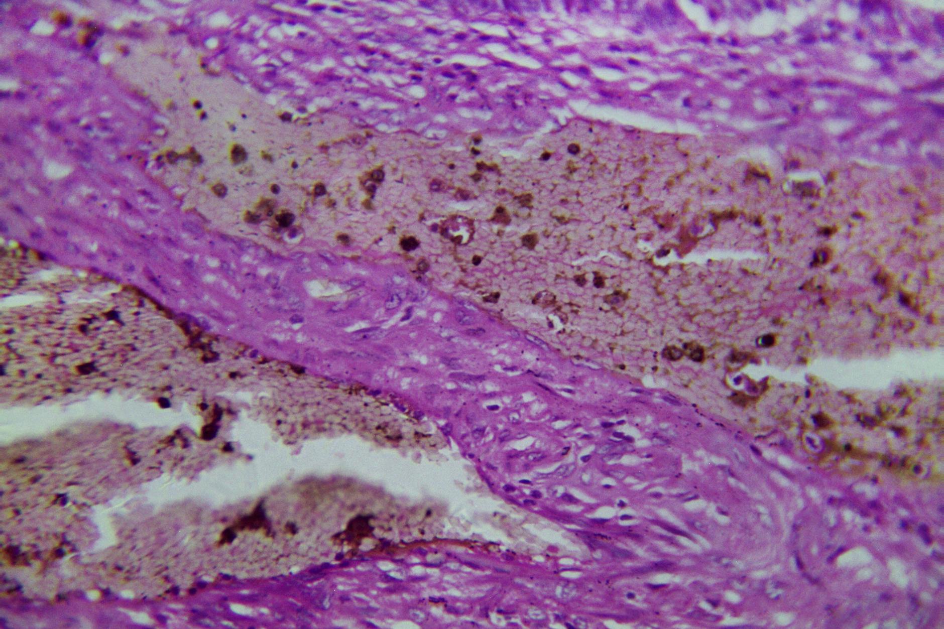 Gewebe eines Dickdarmkarzinoms, mikroskopischer Schnitt