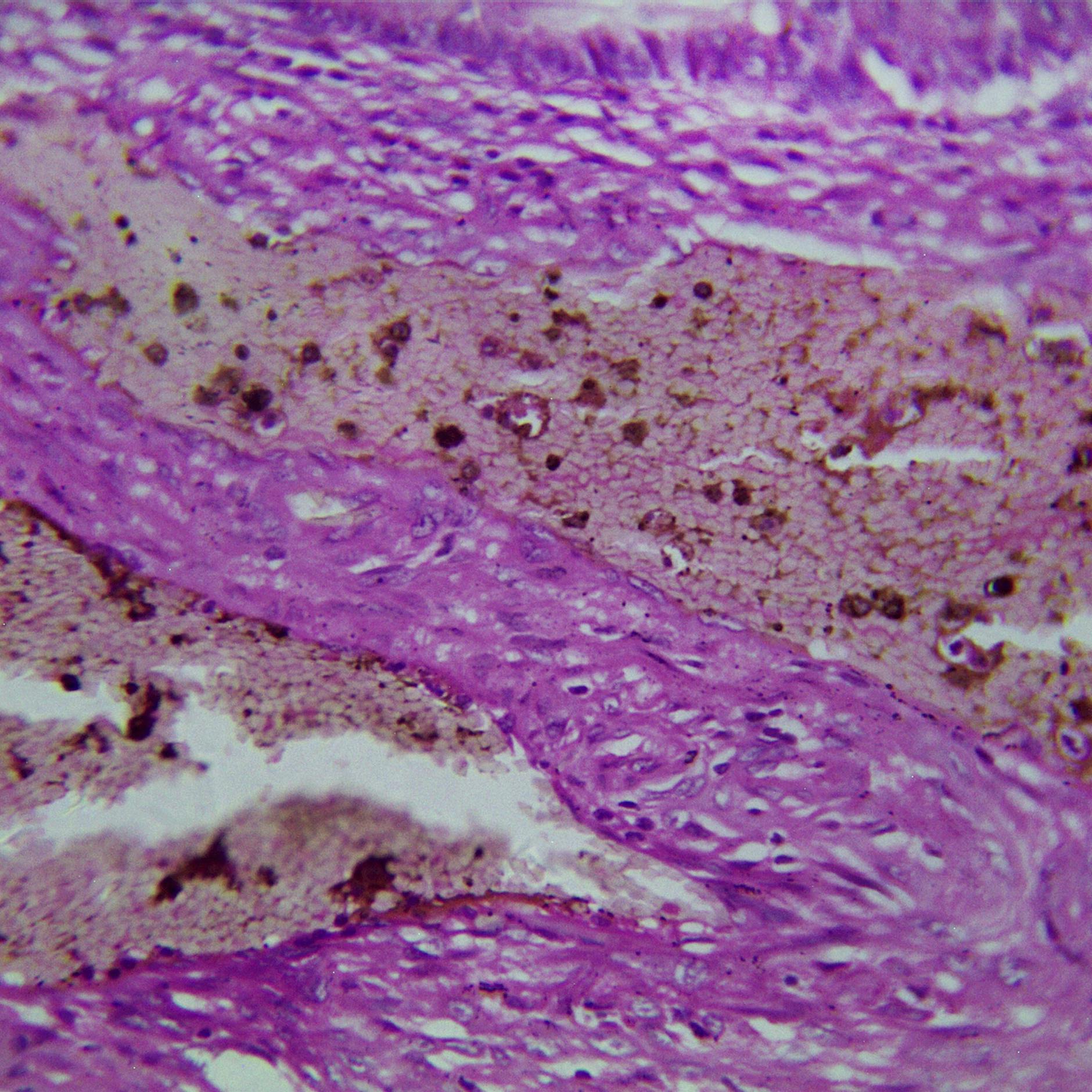 Neue Langzeitstudie: Was das Darmkrebsrisiko deutlich erhöht