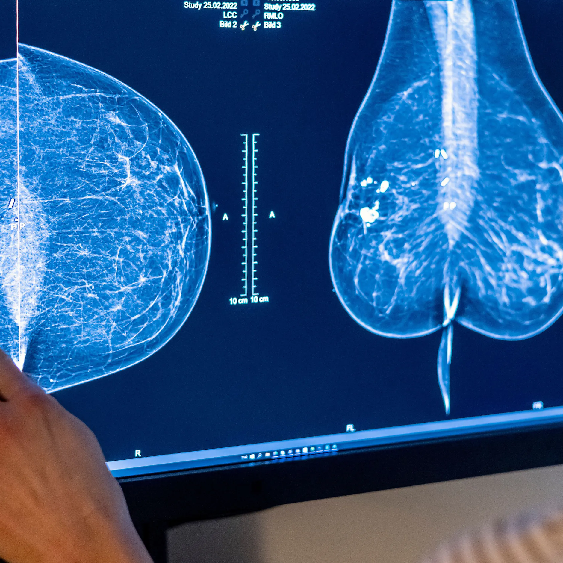 Image - Krebs überlebt, aber nicht gesund? Ein Charité-Programm macht Patientinnen jetzt Hoffnung