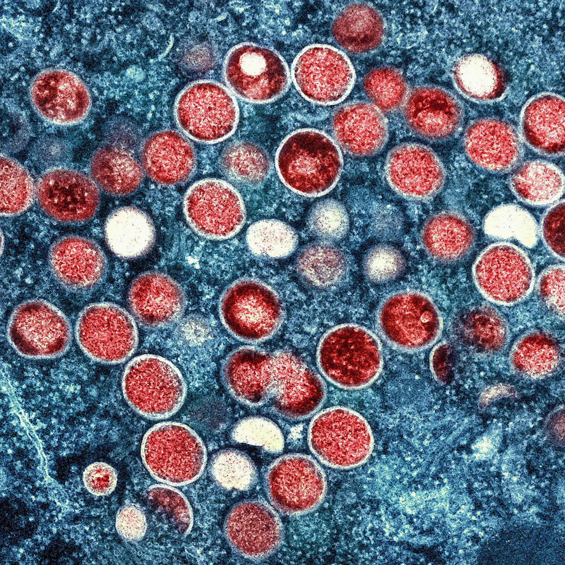 Mpox in Berlin: Zahl der Fälle hat sich stark erhöht