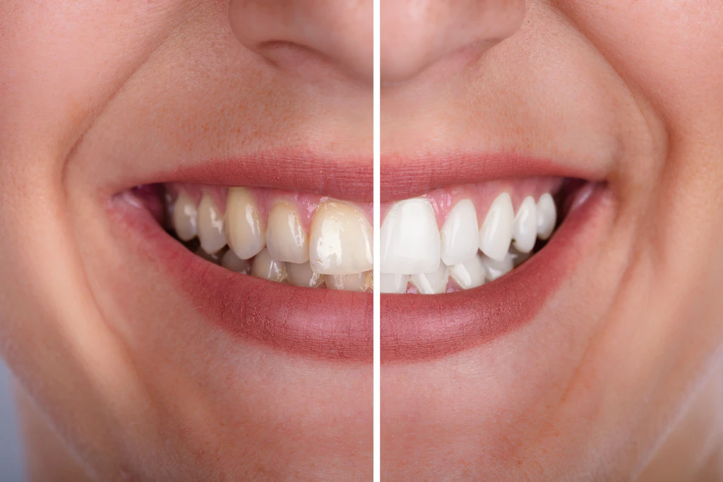 Ob der Effekt so deutlich ist nach der Zahnaufhellung? Zumindest grundsätzlich soll Bleaching bei gesunden Zähnen funktionieren.