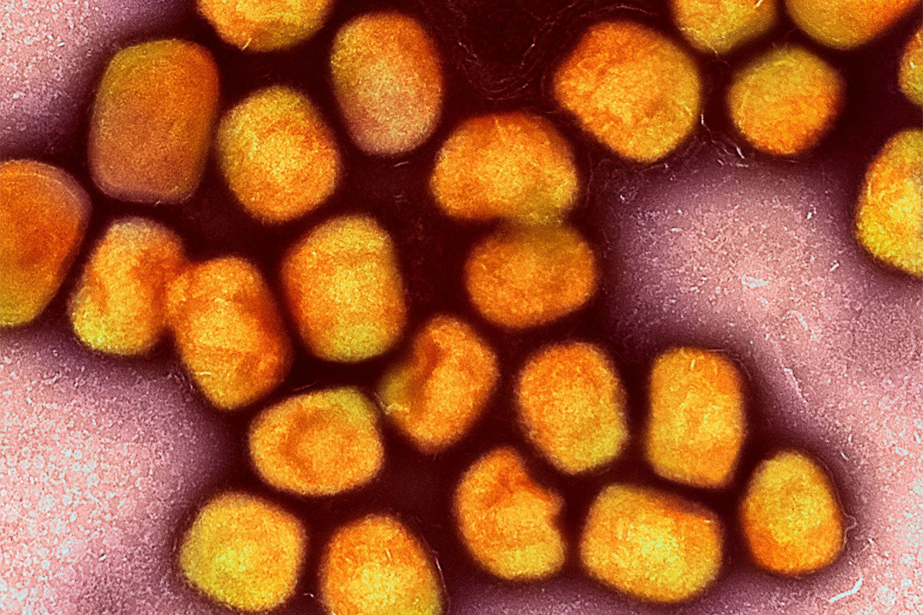 Erstmals hat sich eine Frau aus Berlin mit dem Mpox-Virus angesteckt.