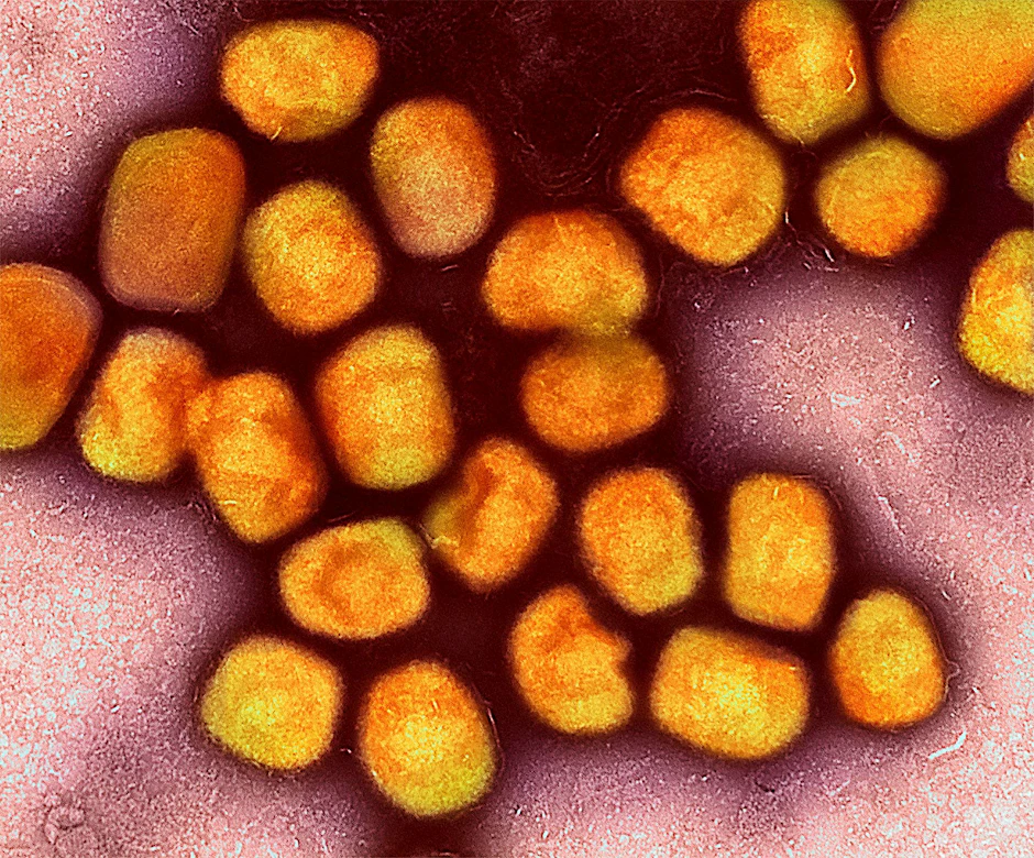 Erstmals hat sich eine Frau aus Berlin mit dem Mpox-Virus angesteckt.