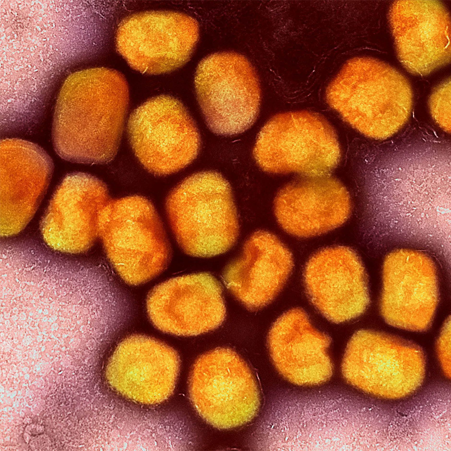 Neue Mpox‑Welle in Berlin – erstmals auch Frau infiziert