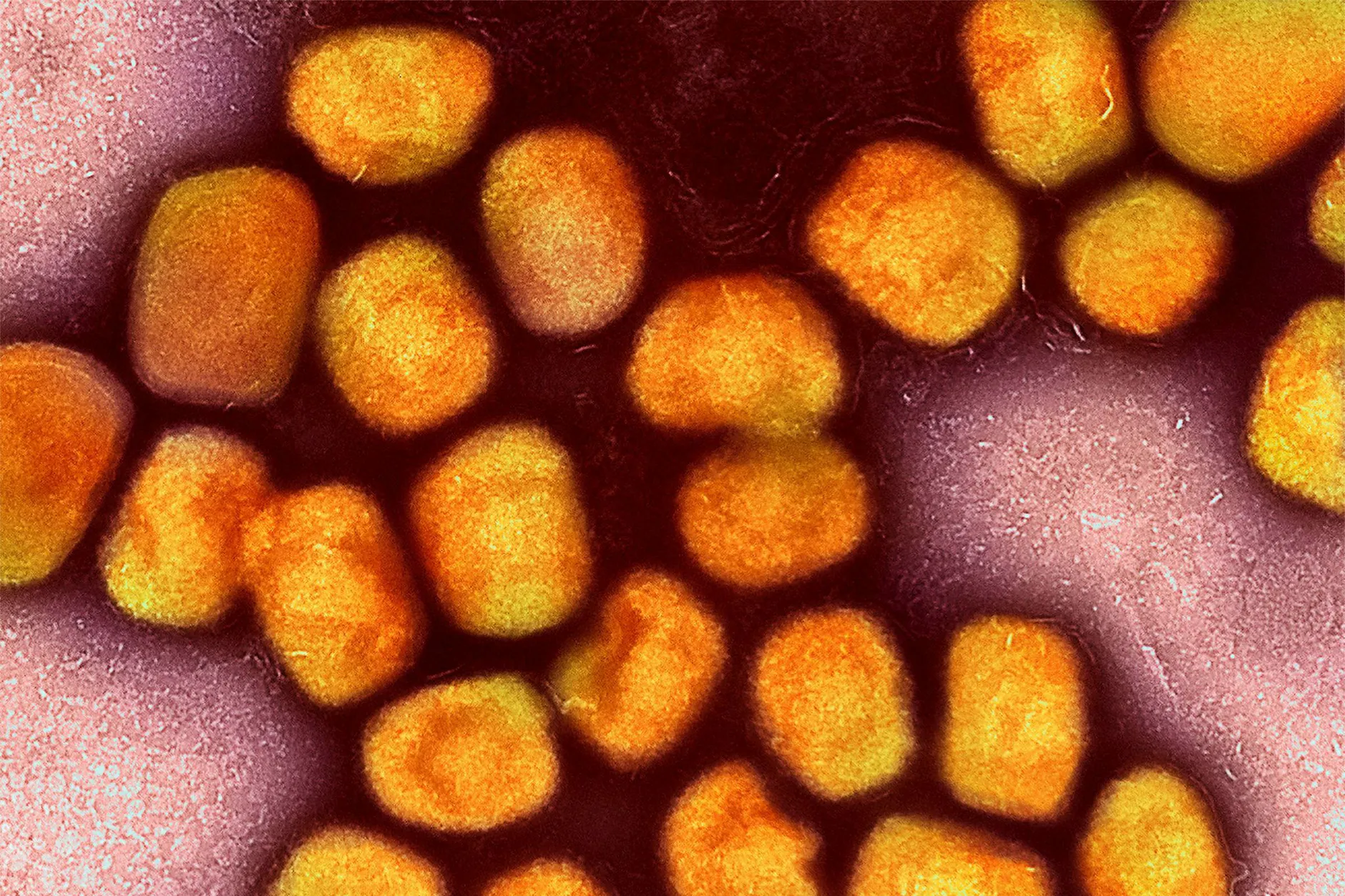 Neue Mpox‑Welle in Berlin – erstmals auch Frau infiziert