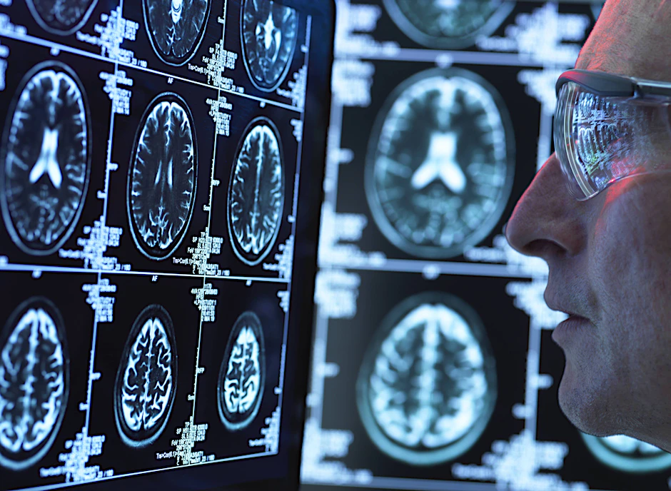 Mit der eigens dafür entwickelten Methode wollen die Forscher künftig auch andere neurologische Erkrankungen untersuchen. (Symbolbild)