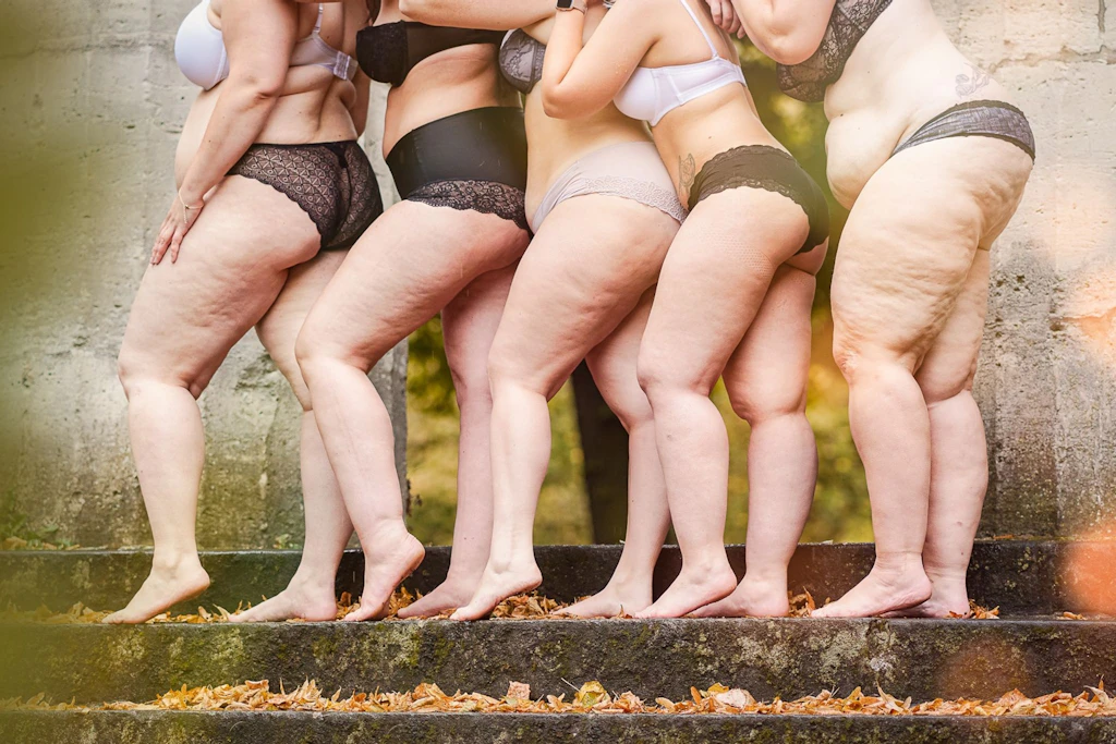 Lipödeme kommen häufiger bei Frauen vor. Die Fettverteilungsstörung kann das Abnehmen deutlich erschweren.