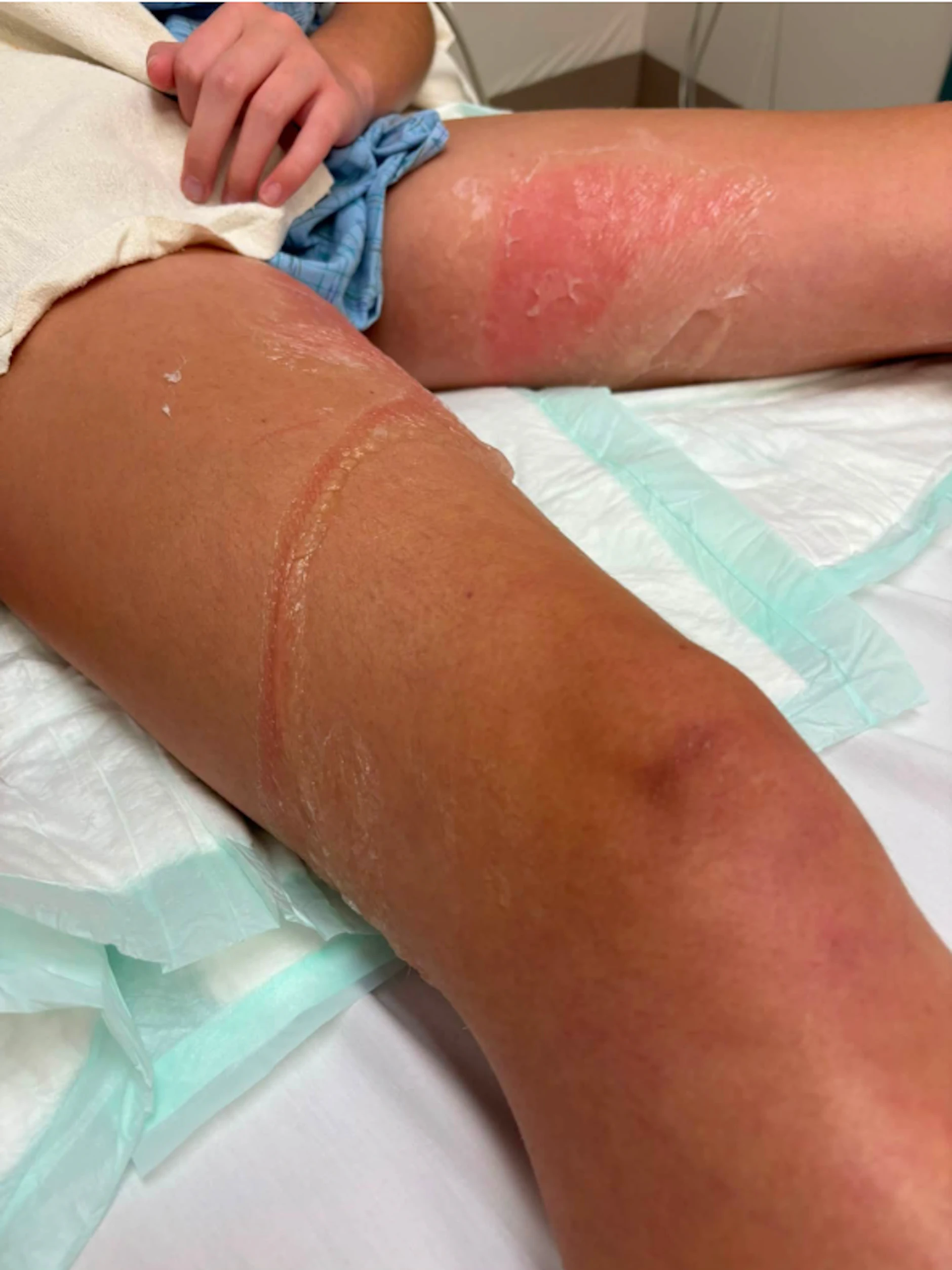 Die Verbrennungen an den Beinen von Natalee, wie sie im Krankenhaus behandelt wurden.