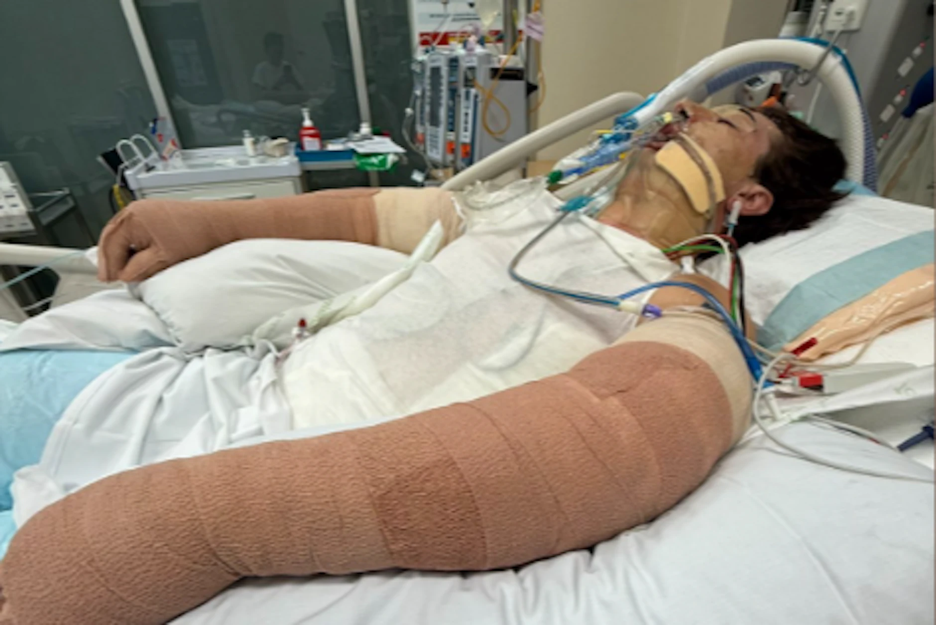 Lachie Perrem (25) liegt mit schweren Verbrennungen am ganzen Körper in einer Klinik. Das Foto hat seine Mutter auf der Spendenplattform Gofundme veröffentlicht.