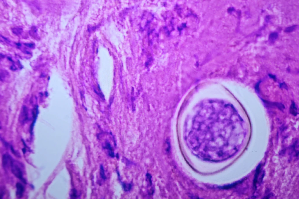 Ist der Pilz erst eingeatmet, bildet er im Gewebe kugelige Sphärulen wie diese – hier unter dem Mikroskop. Aus ihnen entstehen die Endosporen, die Valley Fever im Körper vorantreiben 