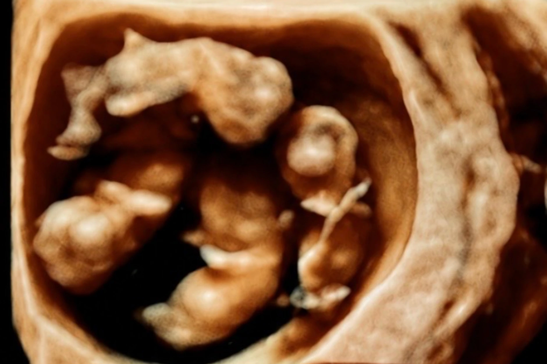 Die eineiigen Vierlinge der Australierin Jenitar Na’amoana während der Schwangerschaft auf einer Ultraschallaufnahme.
