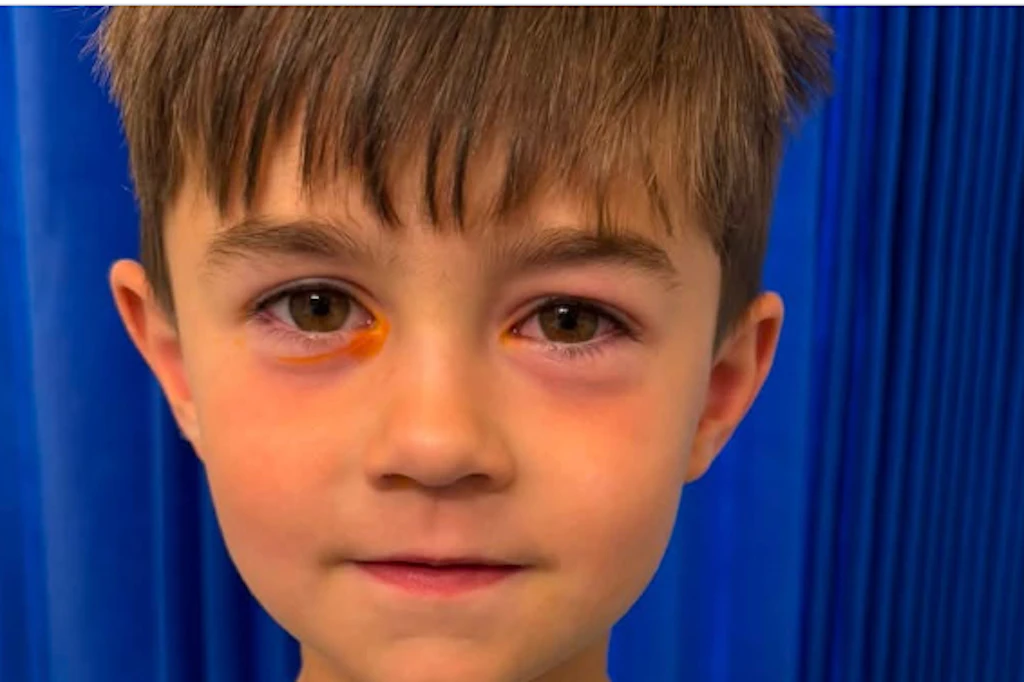 Der vierjährige Hudson wurde von einem geplatzten Squishy-Quetsch-Spielzeug im Gesicht und an den Augen verletzt.