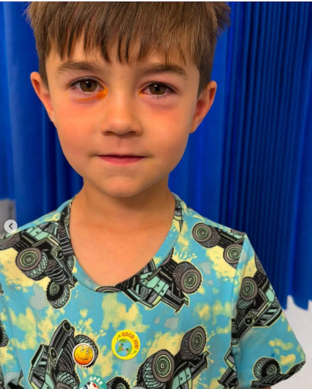Squishy: Quetsch-Spielzeug verätzt vierjährigem Kind die Augen